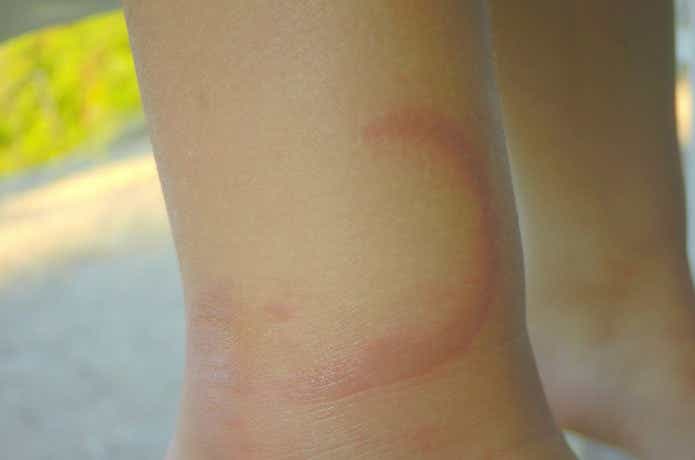 クラゲに刺されたときの治療