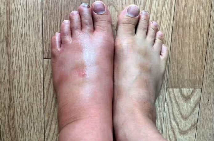 ヒルによる感染症によって腫れた脚