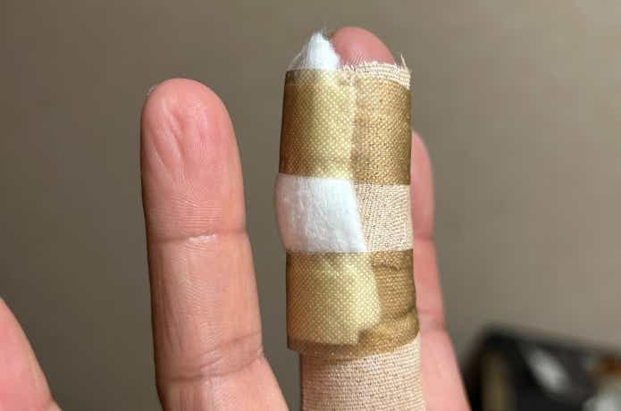 ウツボに噛まれて裂傷を負った指