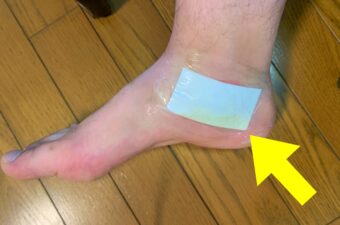 ブヨに噛まれた足