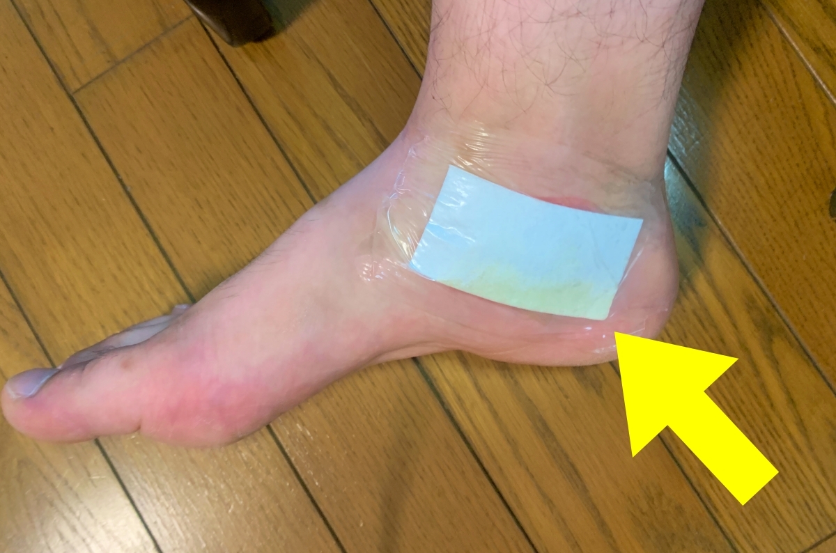 ブヨに噛まれた足